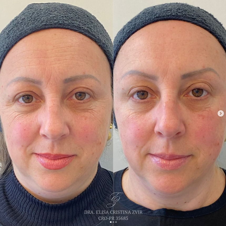 Resultado frontal de harmonização facial
